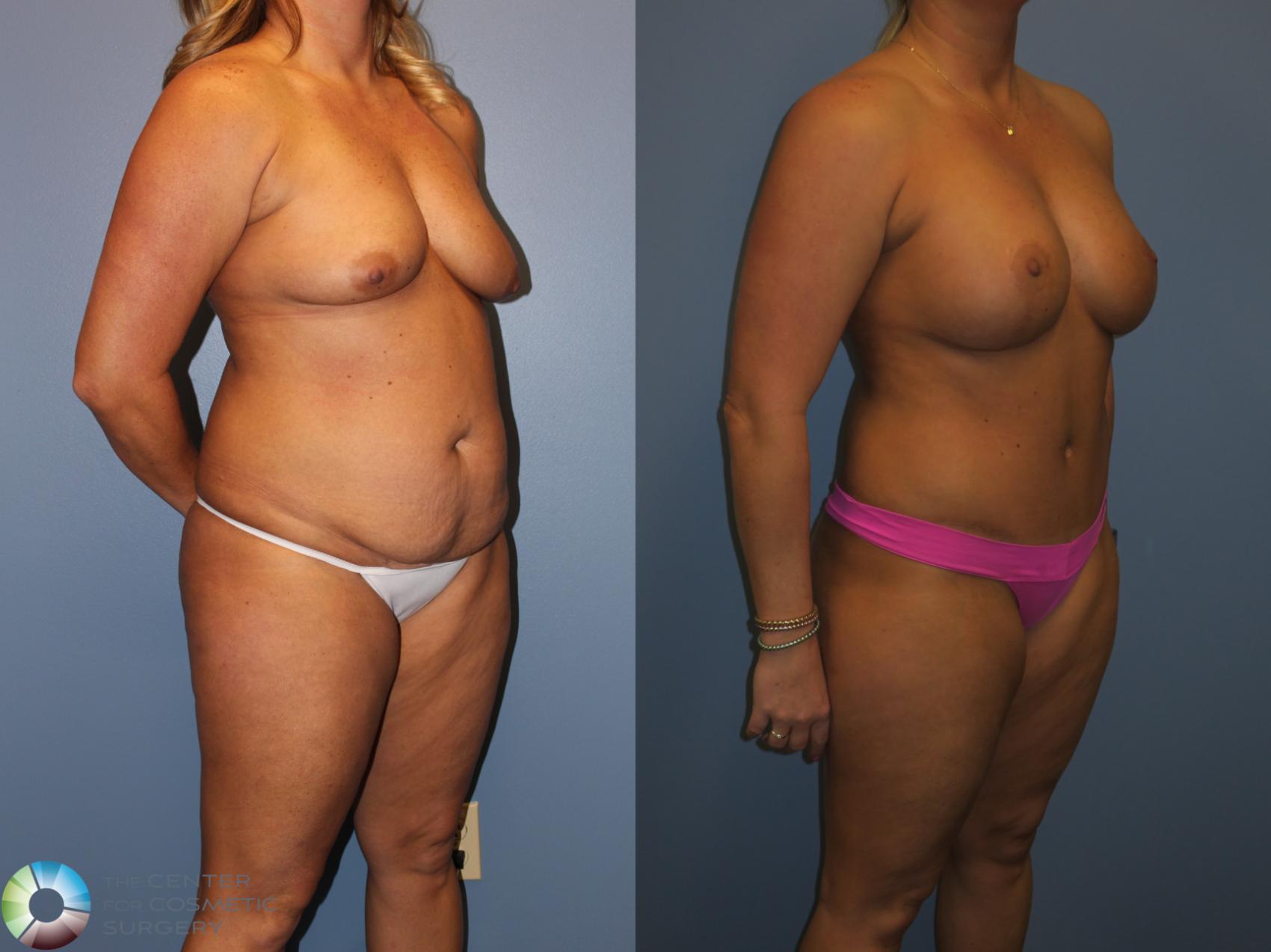 Before & After Power-assisted Liposuction Case 817 View #2 View in Denver & Golden, CO