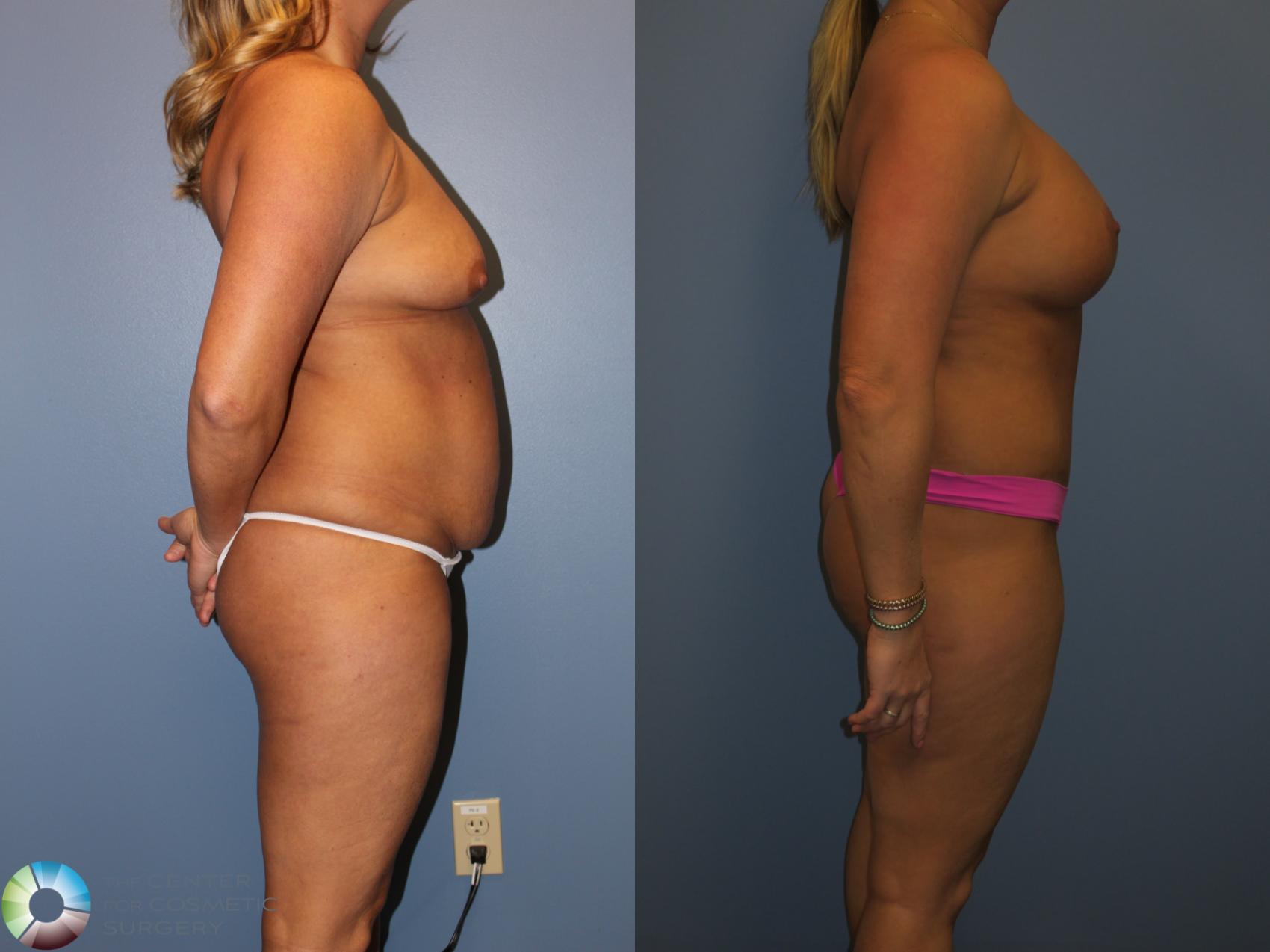 Before & After Power-assisted Liposuction Case 817 View #3 View in Denver & Golden, CO