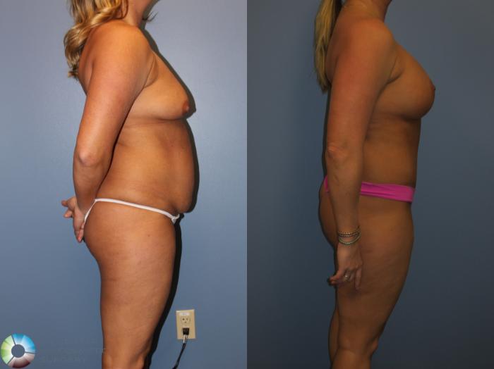 Before & After Power-assisted Liposuction Case 817 View #3 View in Golden, CO