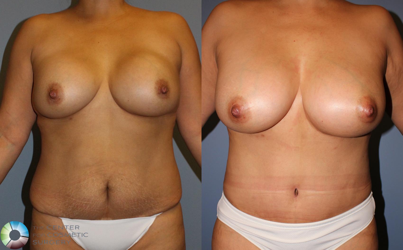 Before & After Breast Implant Revision Case 818 View #1 in Denver, CO