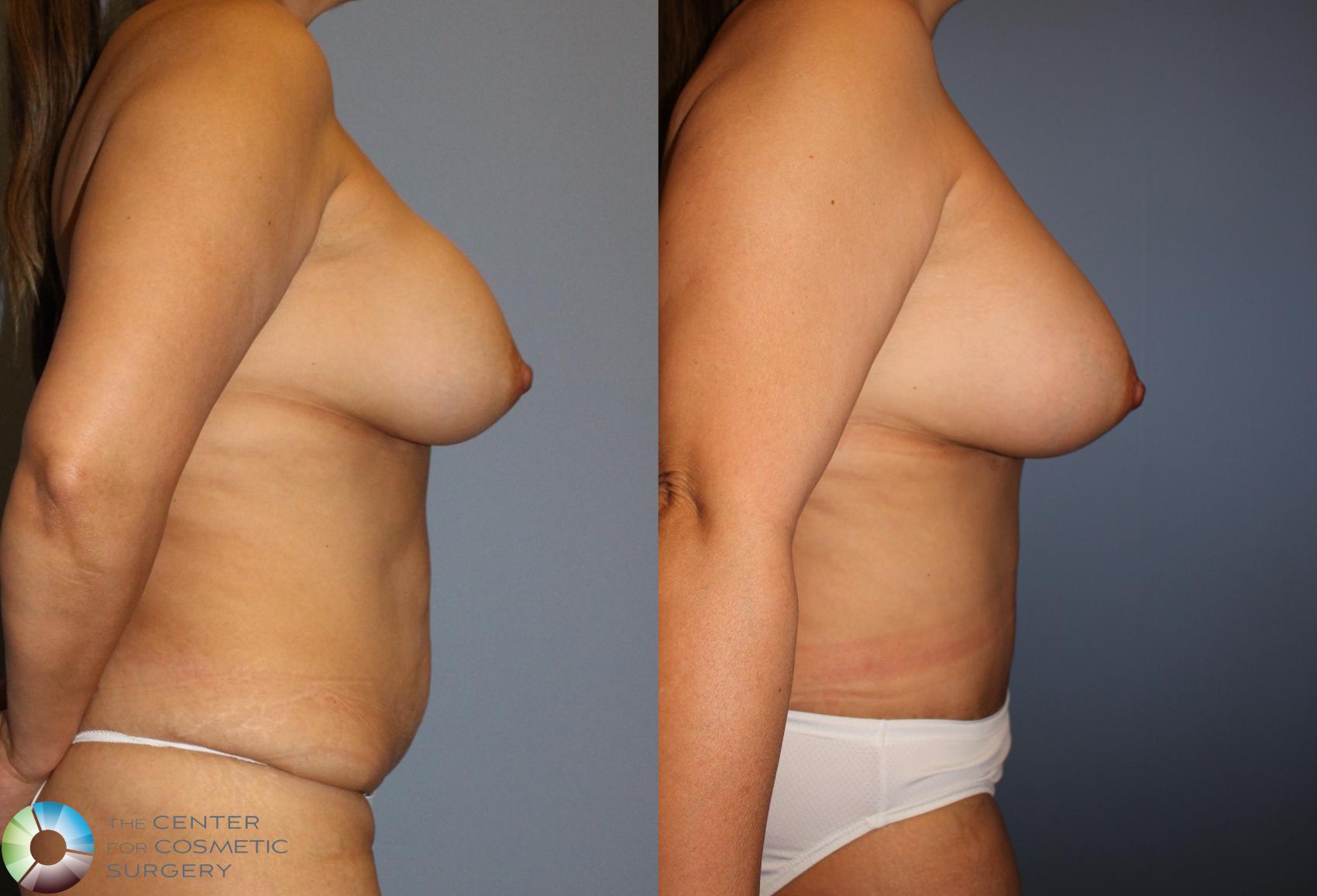 Before & After Mommy Makeover Case 818 View #3 View in Golden, CO