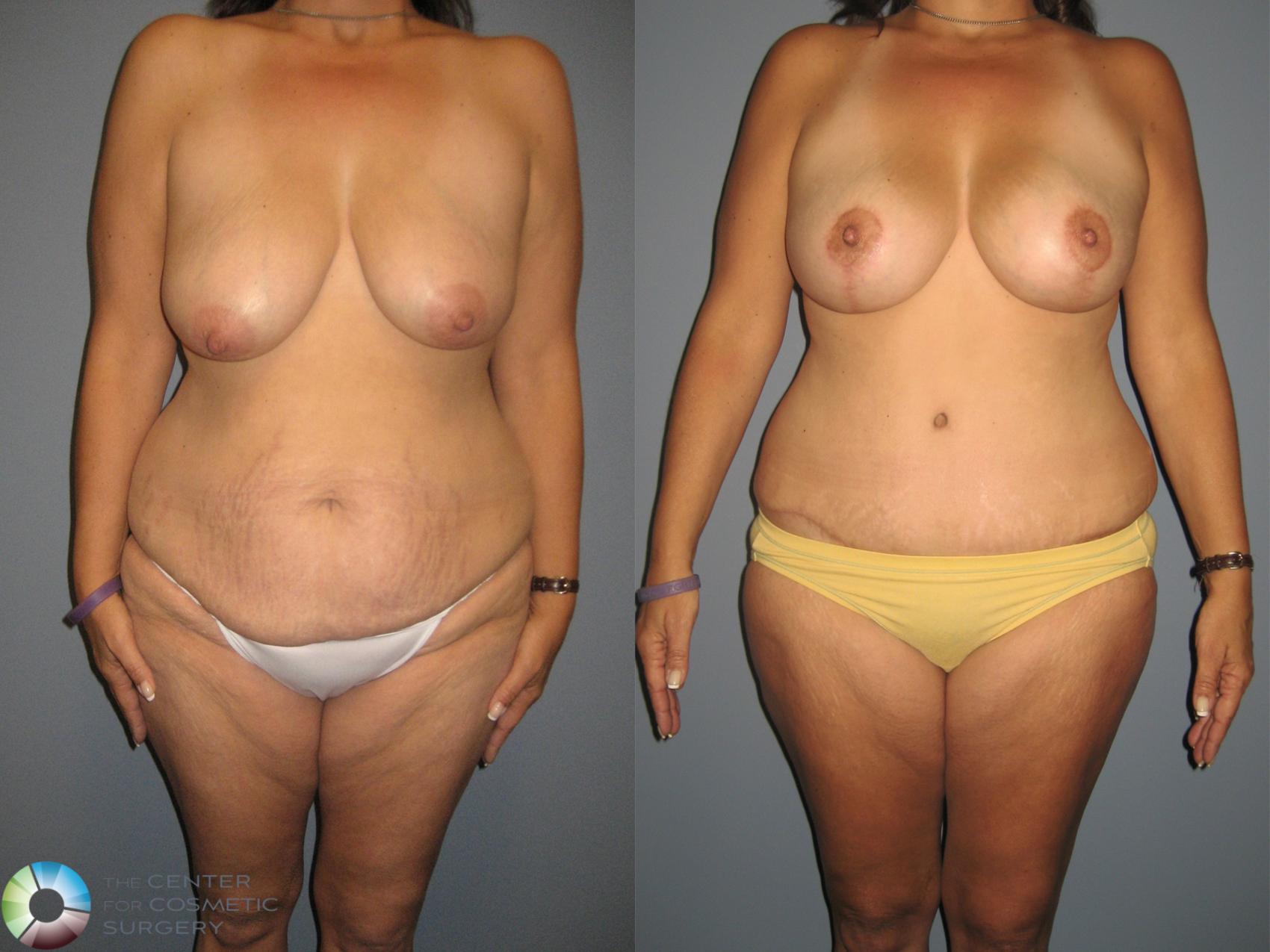 Before & After Mommy Makeover Case 879 View #1 in Denver and Colorado Springs, CO