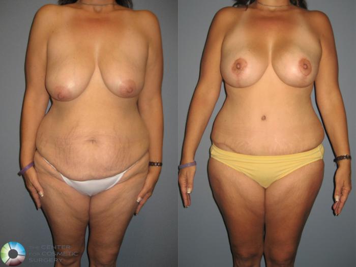 Before & After Breast Lift Case 879 View #1 View in Golden, CO