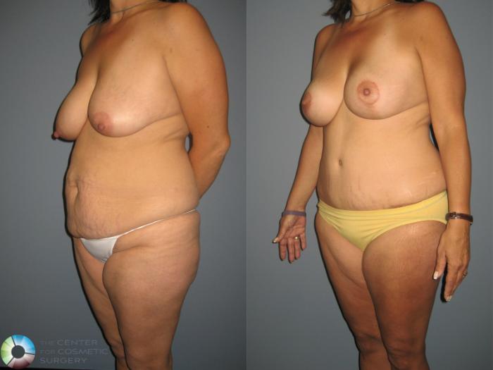 Before & After Breast Lift Case 879 View #2 View in Golden, CO