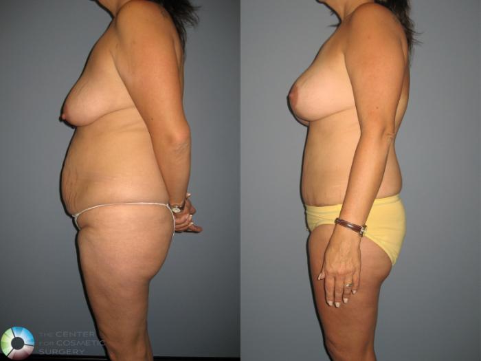 Before & After Tummy Tuck Case 879 View #3 View in Golden, CO