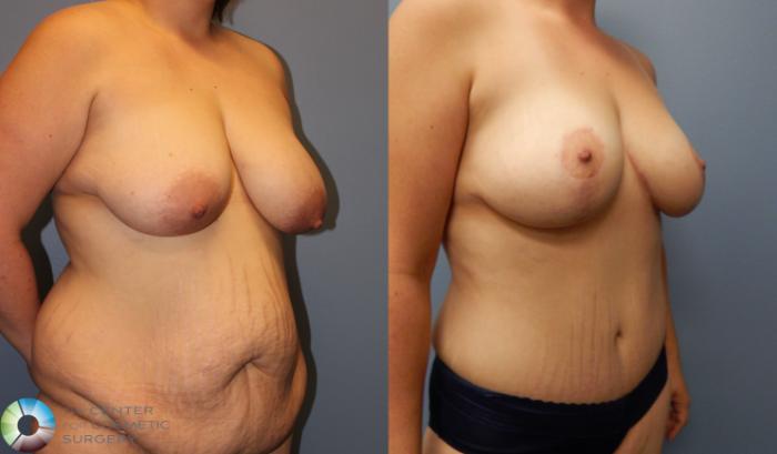 Before & After Tummy Tuck Case 902 View #1 in Denver and Colorado Springs, CO
