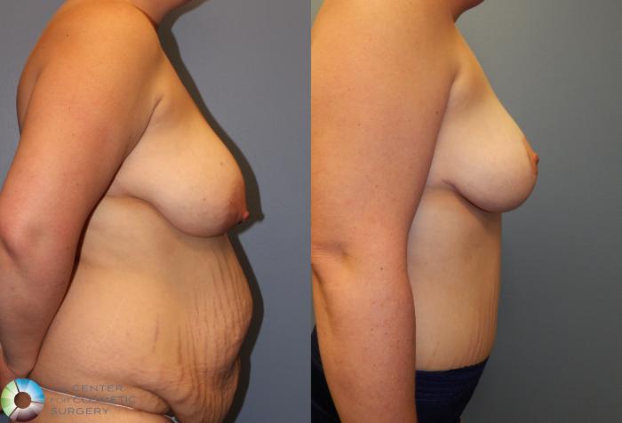 Before & After Tummy Tuck Case 902 View #2 in Denver and Colorado Springs, CO