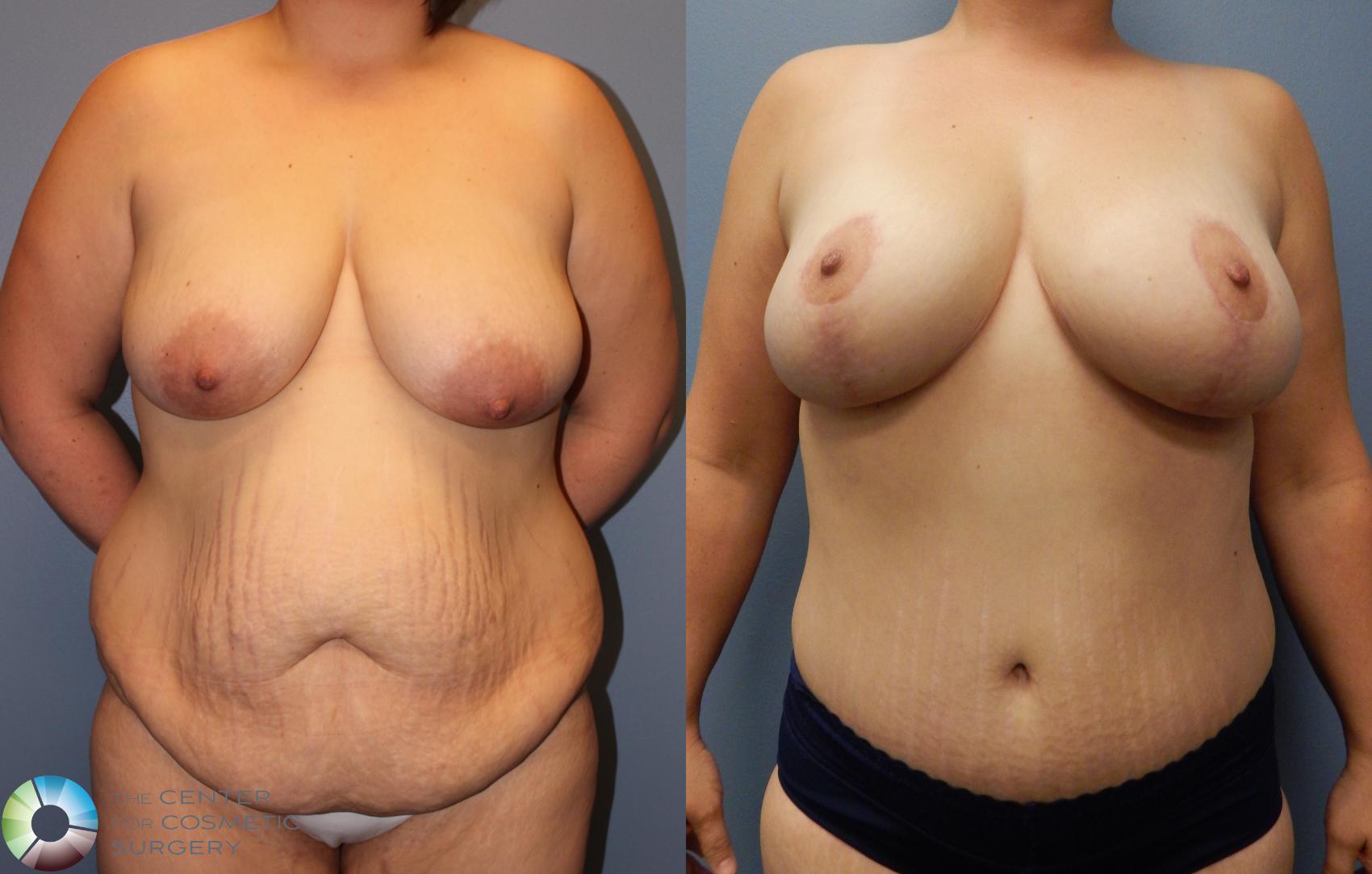 Before & After Mommy Makeover Case 902 View #3 in Denver and Colorado Springs, CO