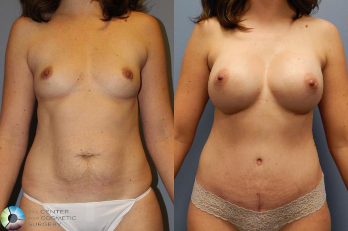 Before & After Mommy Makeover Case 922 Anterior in Denver and Colorado Springs, CO