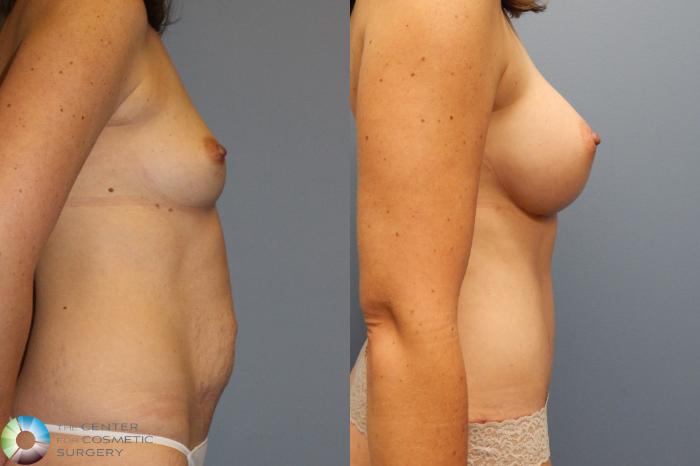 Before & After Mommy Makeover Case 922 Right Lateral in Denver and Colorado Springs, CO