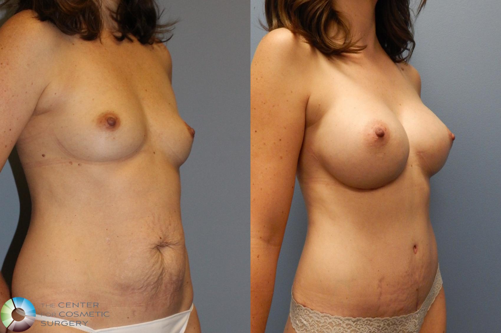 Before & After Mommy Makeover Case 922 Right Oblique in Denver and Colorado Springs, CO