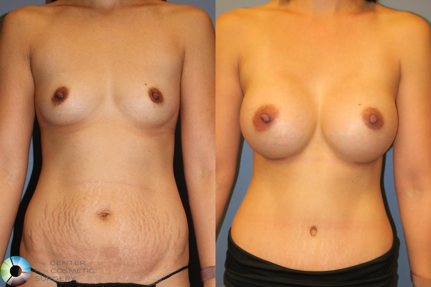 Before & After Mommy Makeover Case 927 Anterior View in Golden, CO