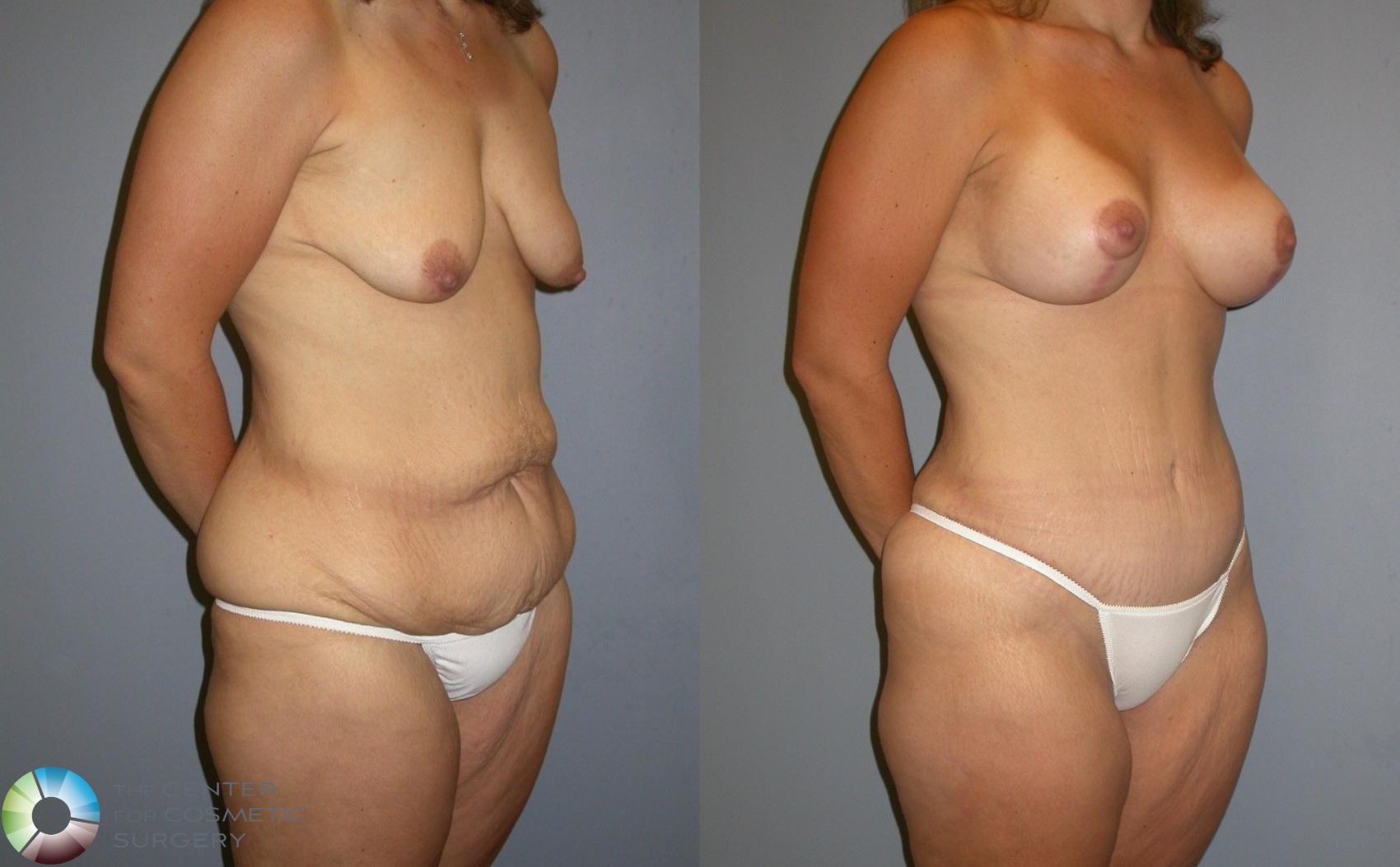 Before & After Tummy Tuck Case 93 View #1 in Denver and Colorado Springs, CO