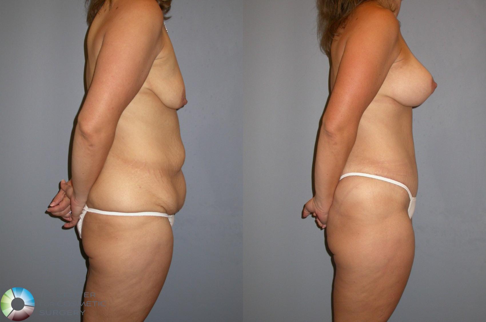 Before & After Mommy Makeover Case 93 View #2 in Denver and Colorado Springs, CO