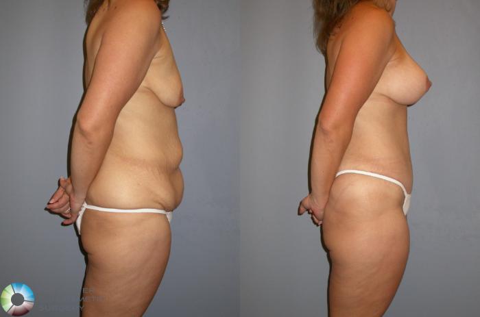 Before & After Tummy Tuck Case 93 View #2 View in Golden, CO