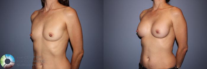 Before & After Motiva Implants® Case 12145 Left Oblique in Denver and Colorado Springs, CO