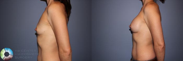 Before & After Motiva Implants® Case 12145 Left Side in Denver and Colorado Springs, CO