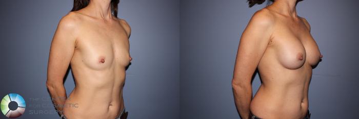 Before & After Motiva Implants® Case 12145 Right Oblique in Denver and Colorado Springs, CO