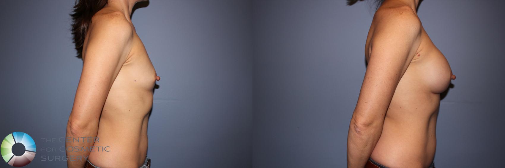 Before & After Motiva Implants® Case 12145 Right Side in Denver and Colorado Springs, CO