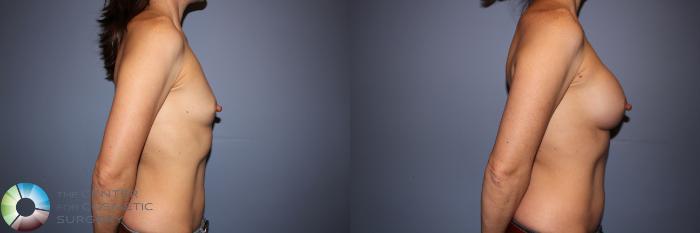 Before & After Motiva Implants® Case 12145 Right Side in Denver and Colorado Springs, CO
