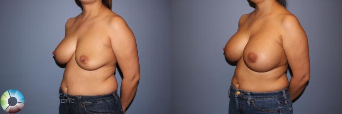 Before & After Motiva Implants® Case 12147 Left Oblique in Denver and Colorado Springs, CO