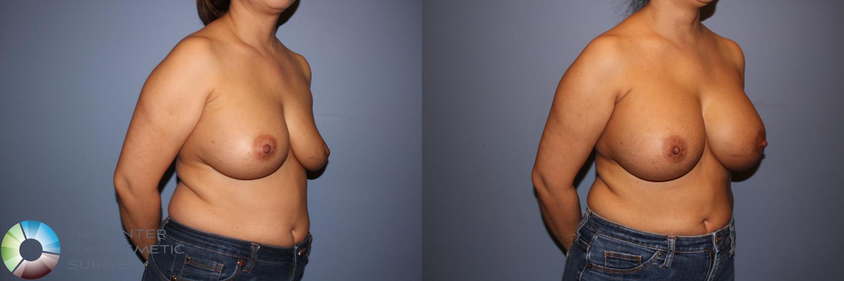 Before & After Motiva Implants® Case 12147 Right Oblique in Denver and Colorado Springs, CO