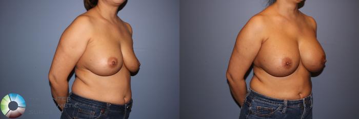 Before & After Motiva Implants® Case 12147 Right Oblique in Denver and Colorado Springs, CO