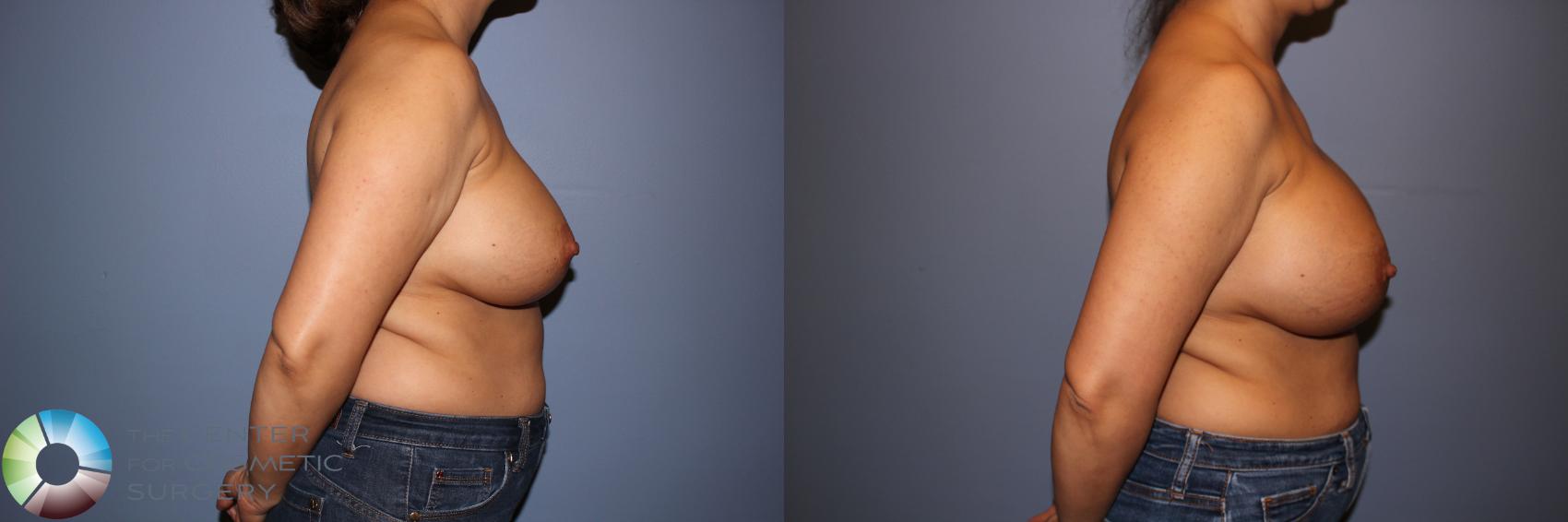 Before & After Motiva Implants® Case 12147 Right Side in Denver and Colorado Springs, CO