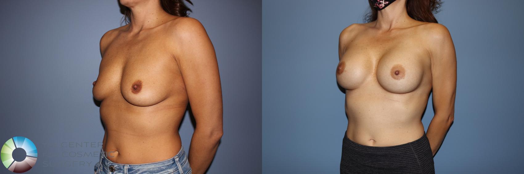 Before & After Motiva Implants® Case 12148 Left Oblique in Denver and Colorado Springs, CO