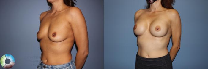 Before & After Motiva Implants® Case 12148 Left Oblique in Denver and Colorado Springs, CO