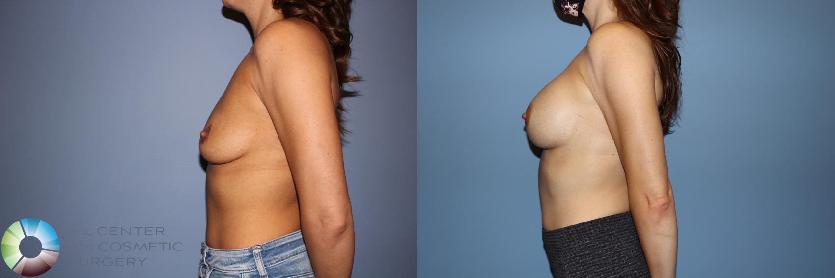 Before & After Motiva Implants® Case 12148 Left Side in Denver and Colorado Springs, CO