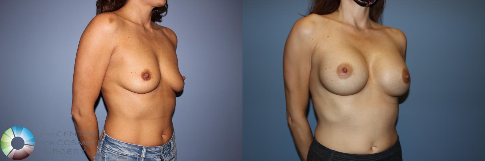 Before & After Motiva Implants® Case 12148 Right Oblique in Denver and Colorado Springs, CO