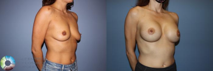 Before & After Motiva Implants® Case 12148 Right Oblique in Denver and Colorado Springs, CO