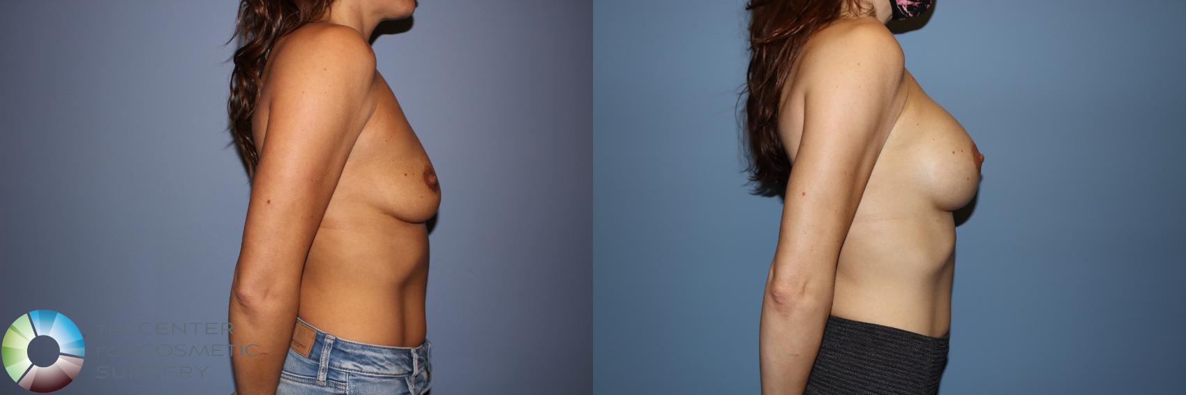 Before & After Motiva Implants® Case 12148 Right Side in Denver and Colorado Springs, CO