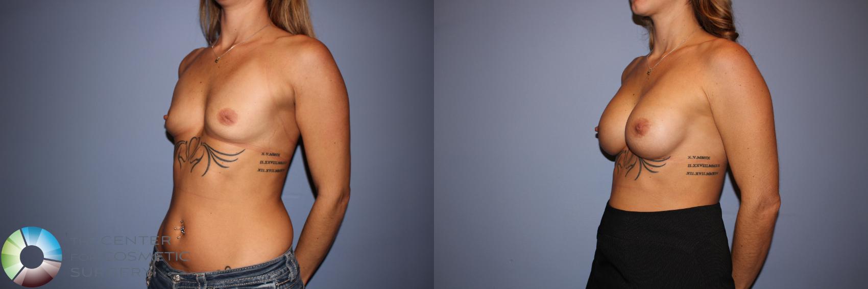 Before & After Motiva Implants® Case 12150 Left Oblique in Denver and Colorado Springs, CO