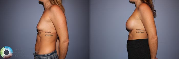 Before & After Motiva Implants® Case 12150 Left Side in Denver and Colorado Springs, CO
