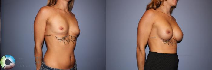 Before & After Motiva Implants® Case 12150 Right Oblique in Denver and Colorado Springs, CO