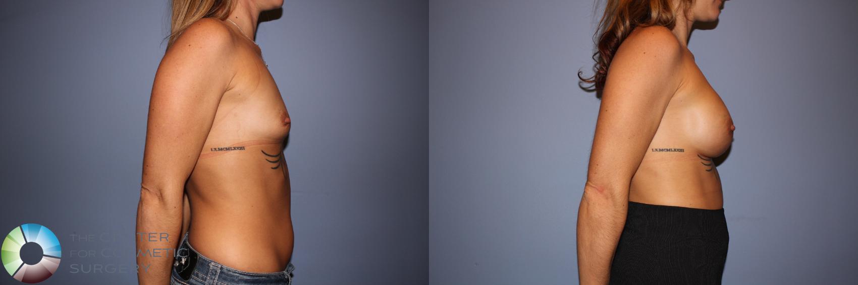 Before & After Motiva Implants® Case 12150 Right Side in Denver and Colorado Springs, CO