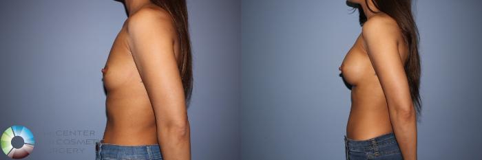 Before & After Motiva Implants® Case 12151 Left Side in Denver and Colorado Springs, CO