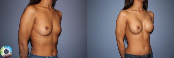Before & After Motiva Implants® Case 12151 Right Oblique in Denver and Colorado Springs, CO