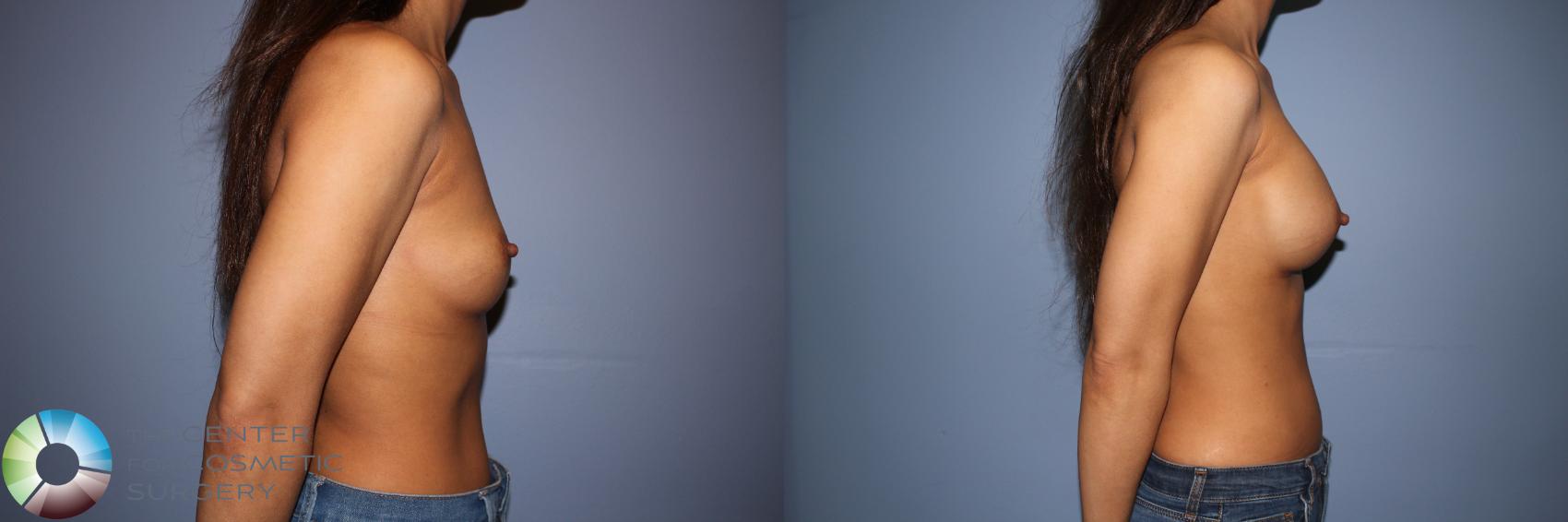 Before & After Motiva Implants® Case 12151 Right Side in Denver and Colorado Springs, CO