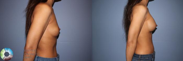 Before & After Motiva Implants® Case 12151 Right Side in Denver and Colorado Springs, CO