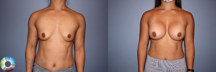 Before & After Motiva Implants® Case 12152 Front in Denver and Colorado Springs, CO