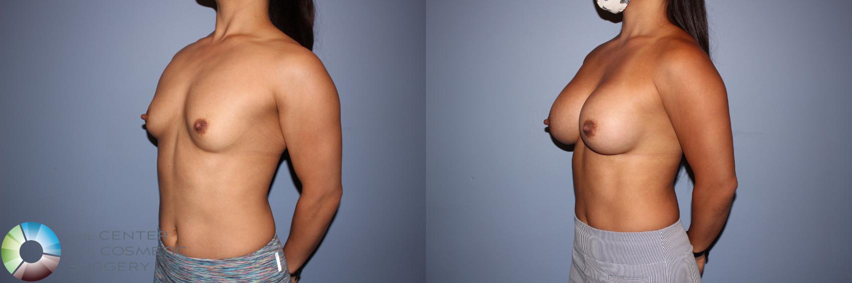 Before & After Motiva Implants® Case 12152 Left Oblique in Denver and Colorado Springs, CO