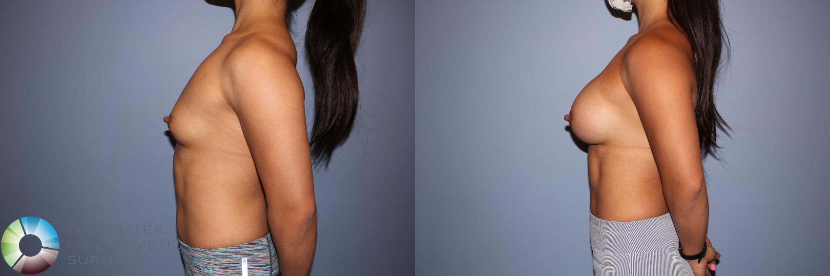 Before & After Motiva Implants® Case 12152 Left Side in Denver and Colorado Springs, CO