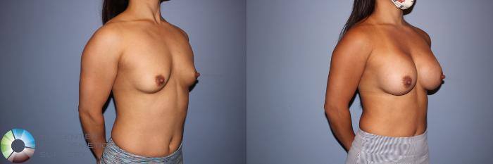 Before & After Motiva Implants® Case 12152 Right Oblique in Denver and Colorado Springs, CO