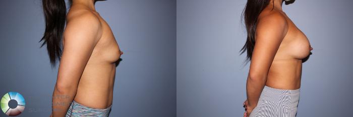 Before & After Motiva Implants® Case 12152 Right Side in Denver and Colorado Springs, CO