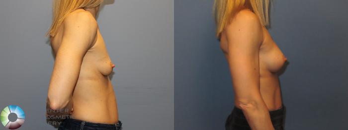 Before & After Small Implant Breast Augmentation (Breast Preservation) Case 12175 Left Side in Denver and Colorado Springs, CO