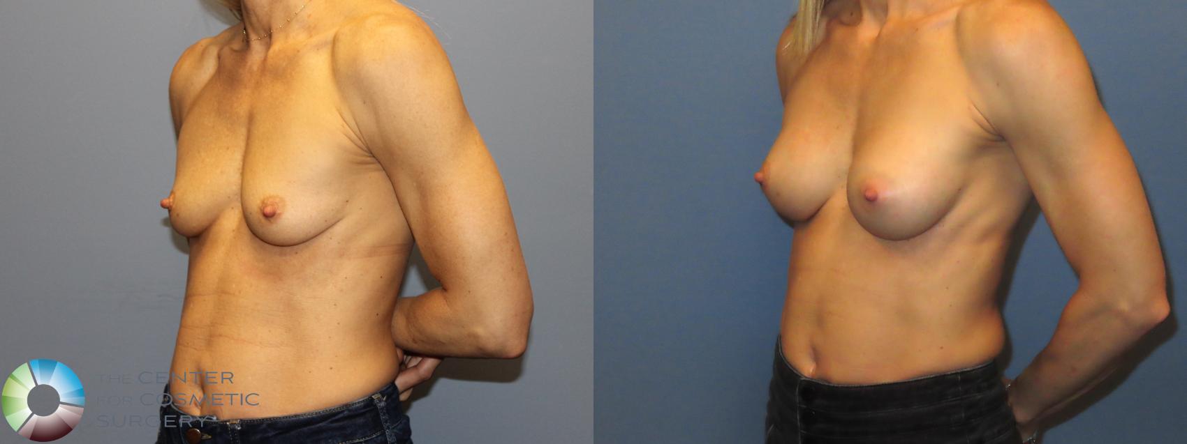 Before & After Motiva Implants® Case 12175 Right Oblique in Denver and Colorado Springs, CO