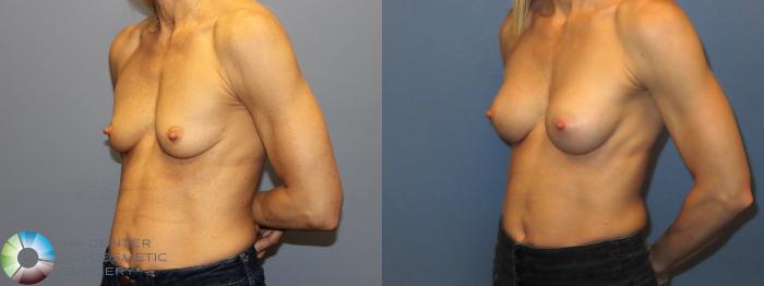 Before & After Small Implant Breast Augmentation (Breast Preservation) Case 12175 Right Oblique in Denver and Colorado Springs, CO